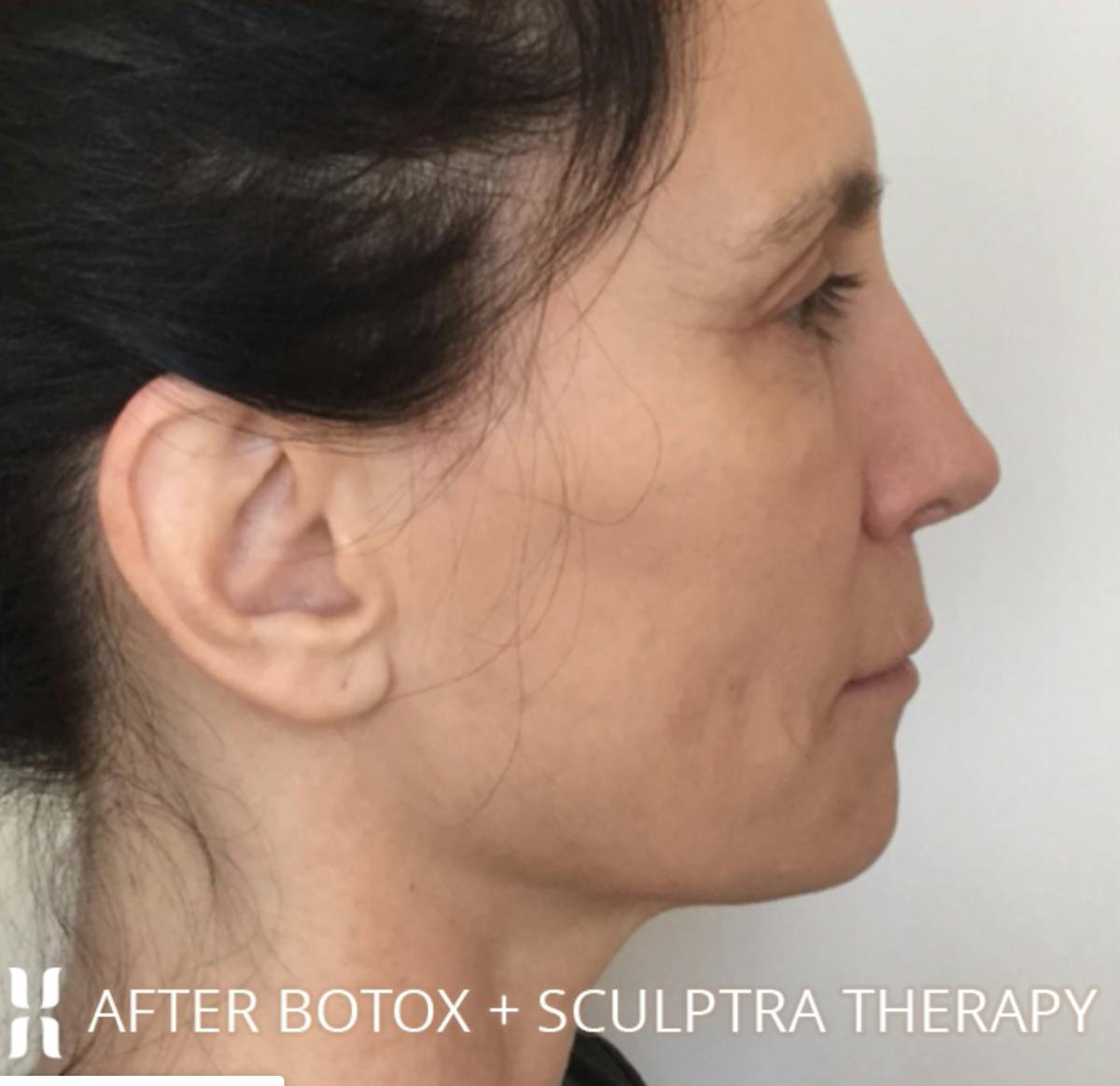 BOTOX Before & After Gallery - Patient 104912 - Image 4