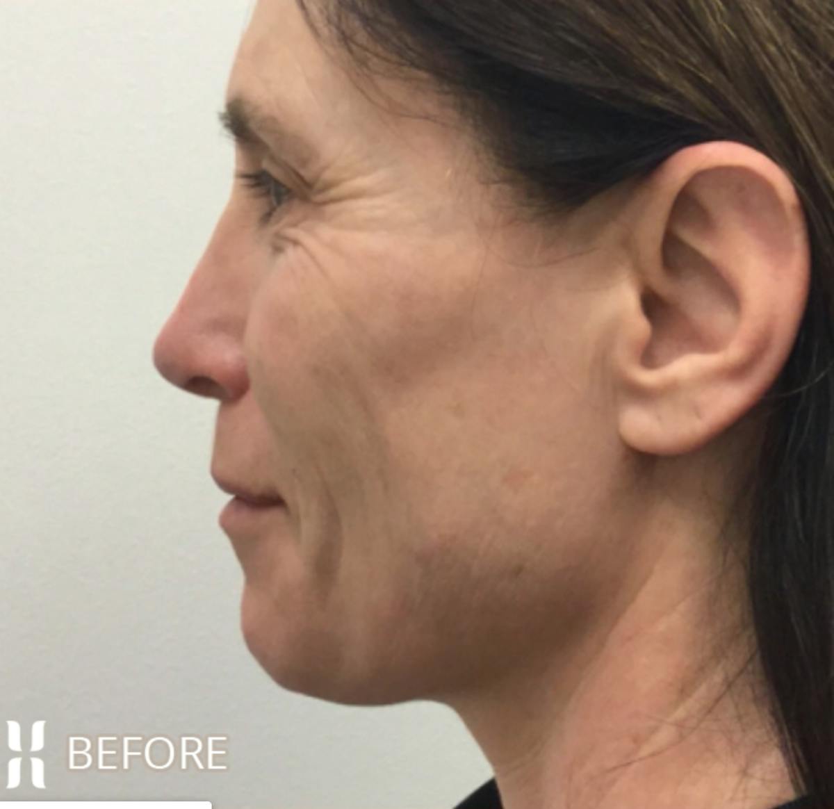 BOTOX Before & After Gallery - Patient 104912 - Image 5