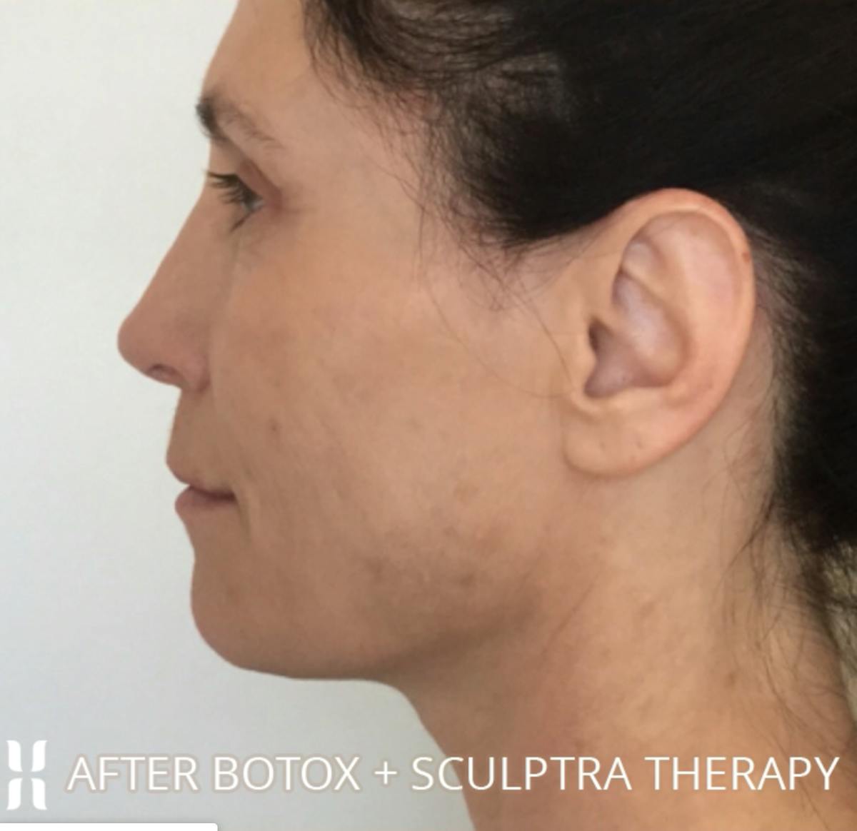 BOTOX Before & After Gallery - Patient 104912 - Image 6