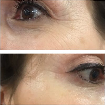 SkinMedica Instant Bright Eye Mask Before & After Gallery - Patient 201287 - Image 1