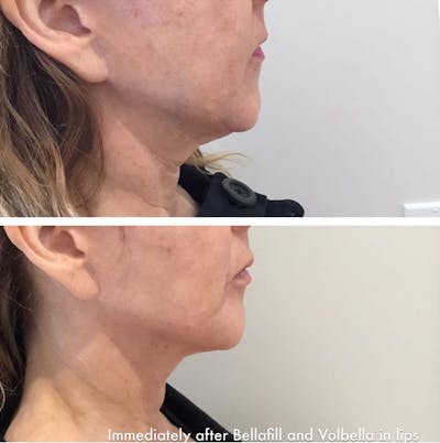 Bellafill Before & After Gallery - Patient 262991 - Image 1
