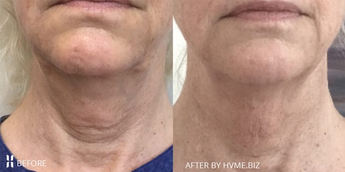 Agnes RF Before & After Gallery - Patient 239369 - Image 1