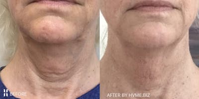 Agnes RF Before & After Gallery - Patient 239369 - Image 1