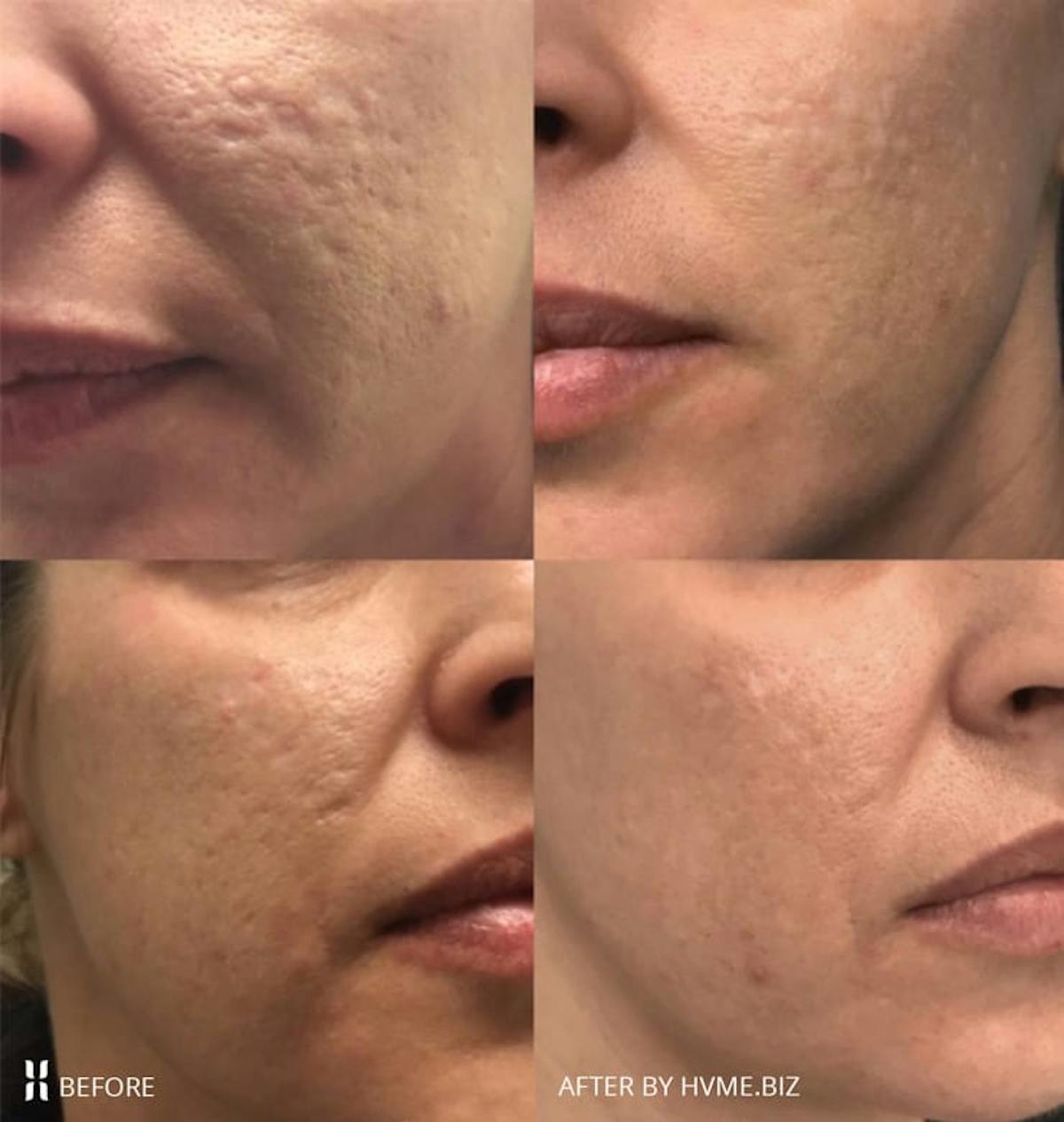 Scarlet RF Before & After Gallery - Patient 114908 - Image 1