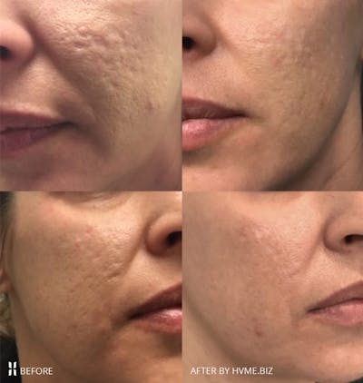 Scarlet RF Before & After Gallery - Patient 114908 - Image 1