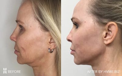 Scarlet RF Before & After Gallery - Patient 483680 - Image 1
