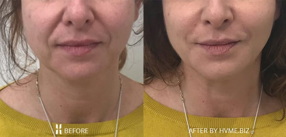 Radiesse Volumizing Filler Before & After Gallery - Patient 302143 - Image 1