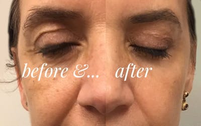 Scarlet RF Before & After Gallery - Patient 224184 - Image 1