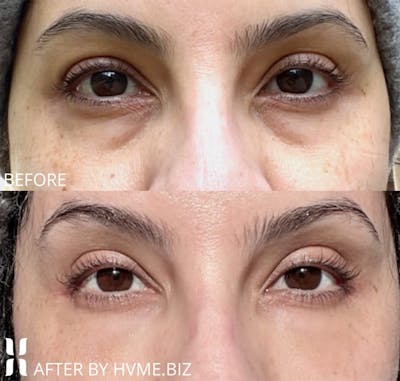 BOTOX Before & After Gallery - Patient 420790 - Image 1