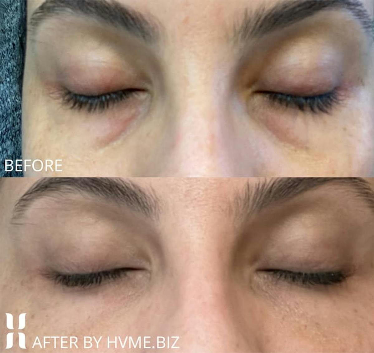 BOTOX Before & After Gallery - Patient 420790 - Image 2