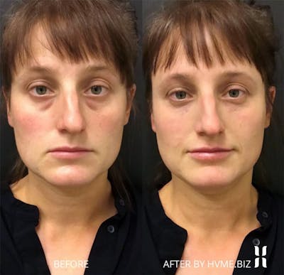 Belotero Balance Before & After Gallery - Patient 299537 - Image 1