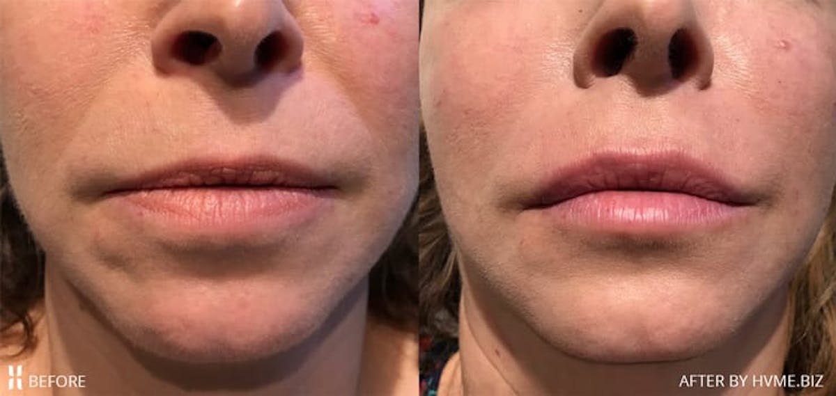Juvéderm Collection Before & After Gallery - Patient 173884 - Image 1