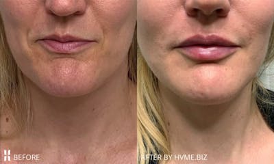 Restylane Before & After Gallery - Patient 261285 - Image 1