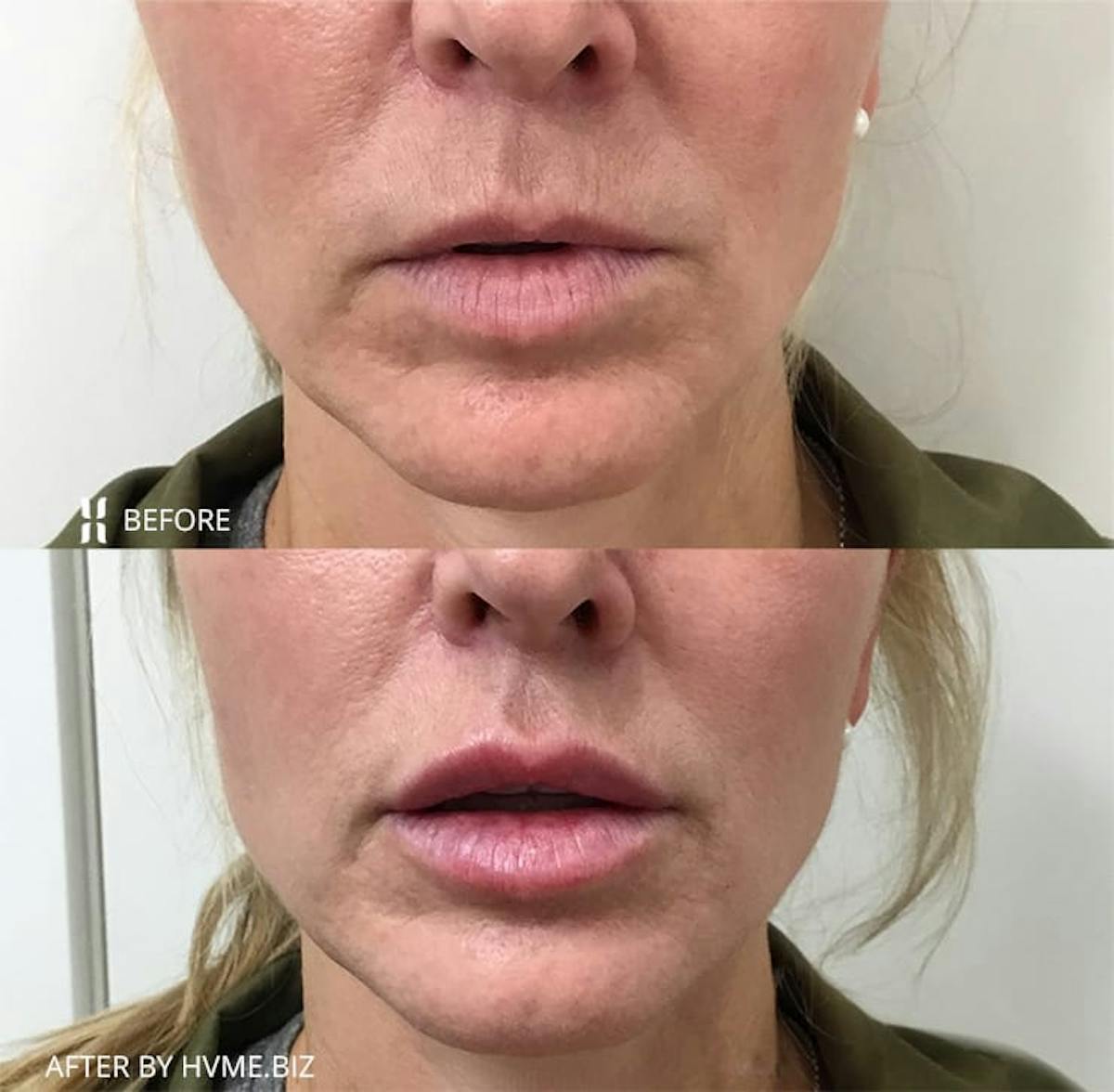 Restylane Before & After Gallery - Patient 352513 - Image 1