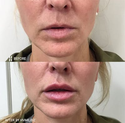 Restylane Before & After Gallery - Patient 352513 - Image 1