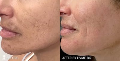 Clear + Brilliant Before & After Gallery - Patient 339473 - Image 1