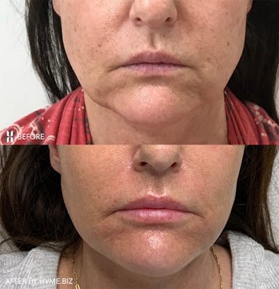 Photofacial (IPL) Before & After Gallery - Patient 123677 - Image 1