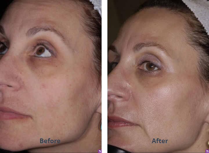 HVM-skin-brightening-cream-before-after