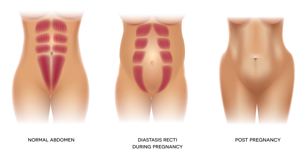 Diastasis Recti (DR)