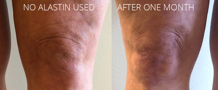 Saggy Knee Skin Before and After