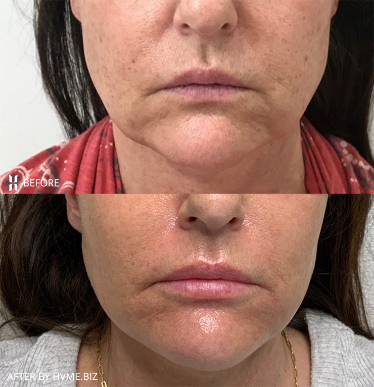 Agnes Precision RF Microneedling, Scarlet RF Microneedling, IPL (Intense Pulsed Light), and Lip Filler