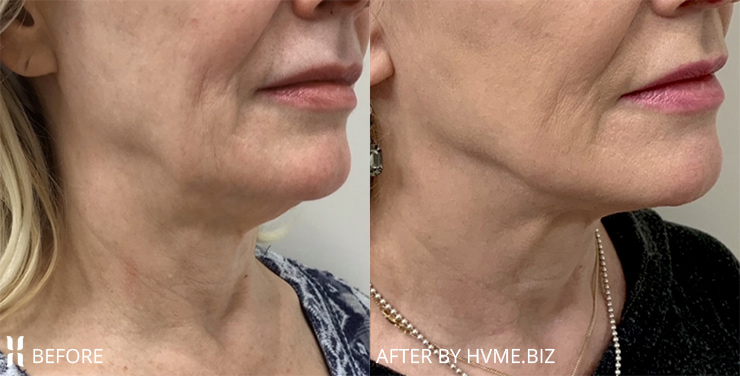 Agnes Precision RF Microneedling, Scarlet RF Microneedling