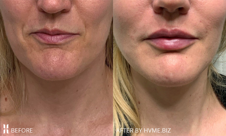 Botox, Kysse and Defyne for lips and marionette lines