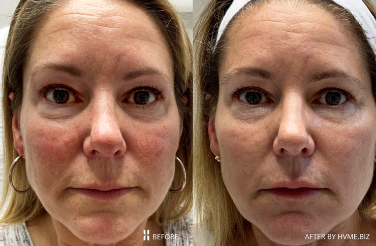 Three months after one Intense Pulsed Light treatment