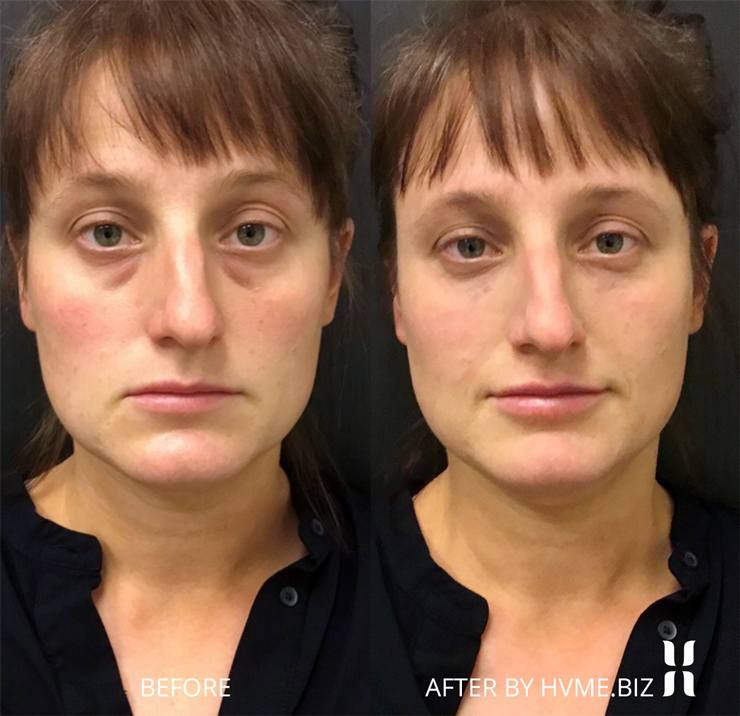 Refyne Lift and Belotero Balance combination treatment