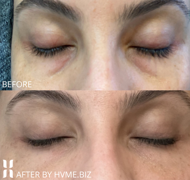 One month after Belotero Balance and Botox Cosmetic to treat tear trough