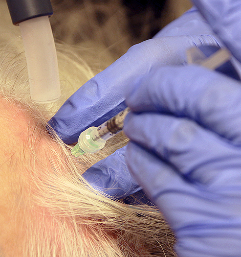 Hair Regrowth Treatment