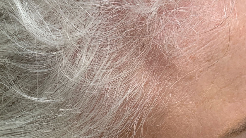 hair regrowth