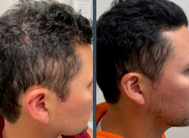Hair Restoration with Scarlet RF and Exosomes