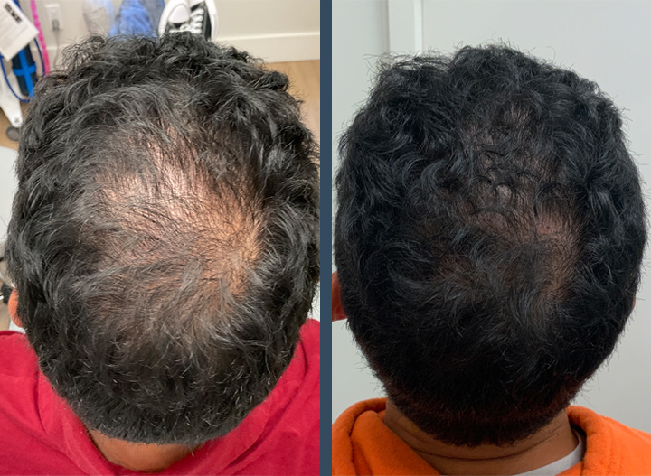 Hair Restoration with Scarlet RF and Exosomes