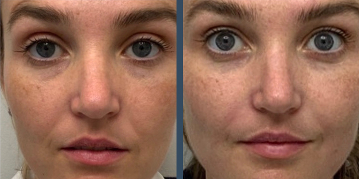 Upneeq for Droopy Eyelids