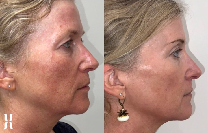 Age Jet Plasma Rejuvenation