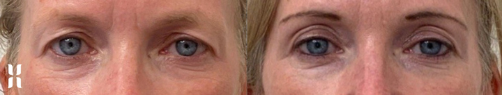 Age Jet Plasma Rejuvenation for non-surgical blepharoplasty 