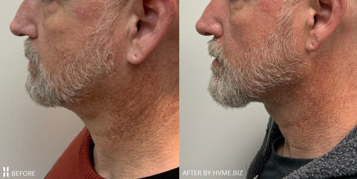 Scarlet RF Microneedling and Agnes RF Microneedling
