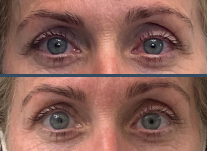 Upneeq for droppy eyelids