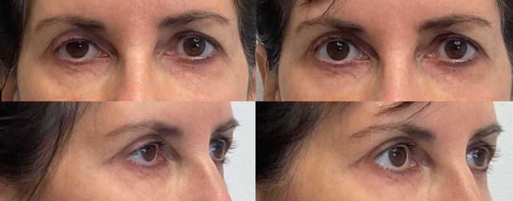Upneeq for correction of facial asymmetry