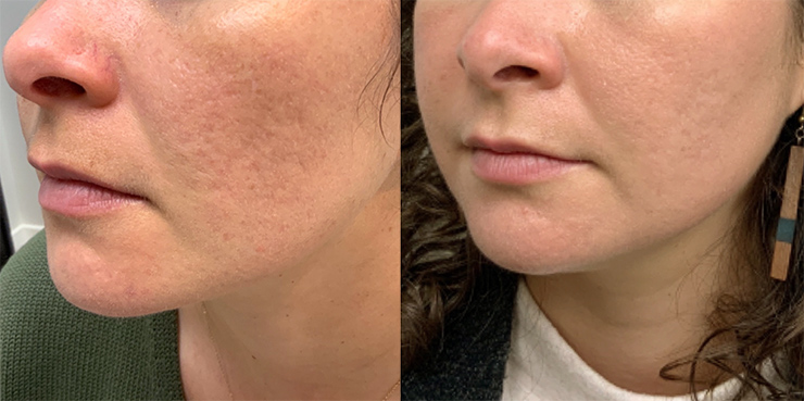 Fraxel Dual, IPL and Exosomes