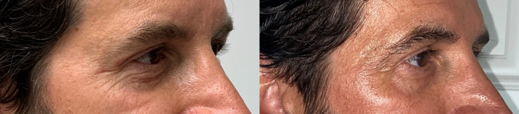 Scarlet RF Microneedling