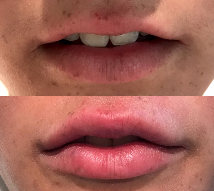 ight-after-1cc-juvederm