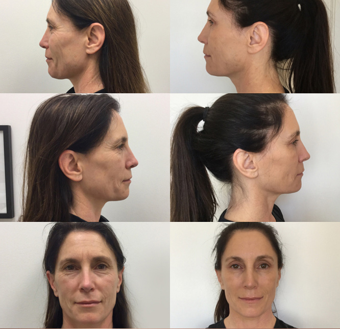 before and after botox and sculptra aesthetic