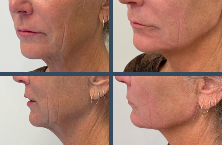 Before and immediately after Volux XC