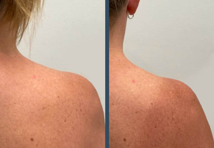 TrapTox before and after photo