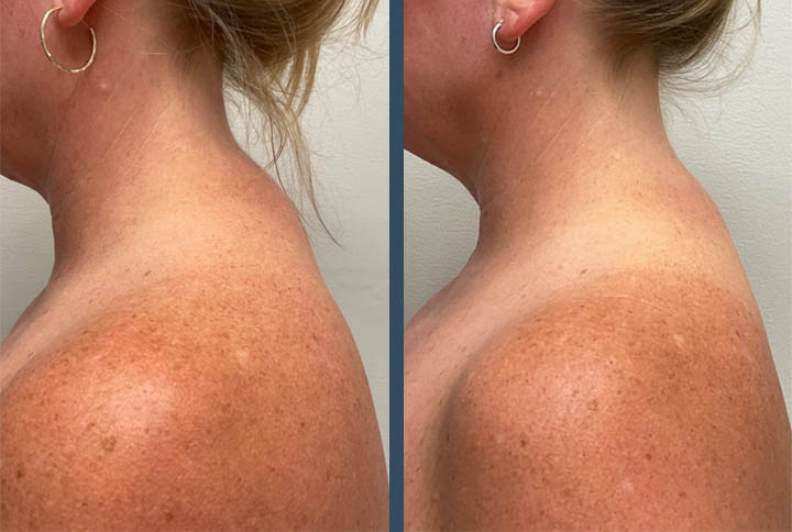 TrapTox before and after photo