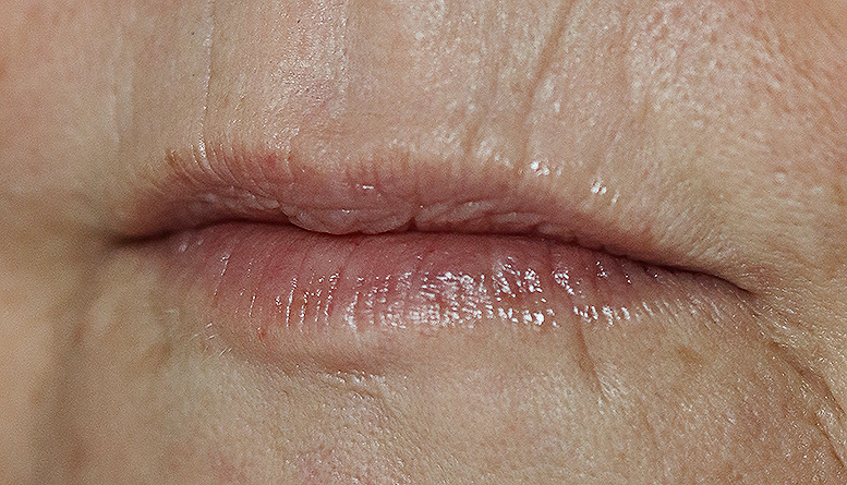 Aging thin lips and loss of vermilion border