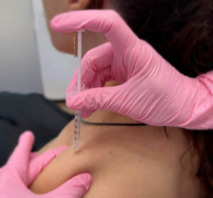 TrapTox Trapezius Injections