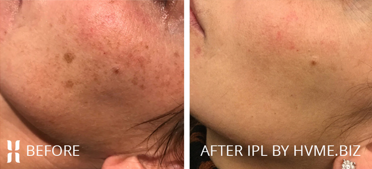 HVME before and after photo - One Intense Pulsed Light/IPL treatment and brightening pads 4% 